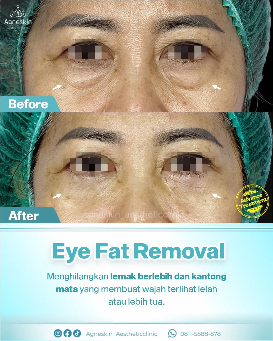 Before After Eye Fat Removal
